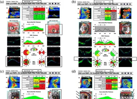 AI Deep Learning Algorithm for Discriminating Ungradable OCT 3D Optic Disc Scans